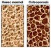 Osteoporosis masculina, la gran olvidada