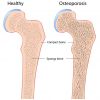 Alimentación preventiva contra la osteoporisis